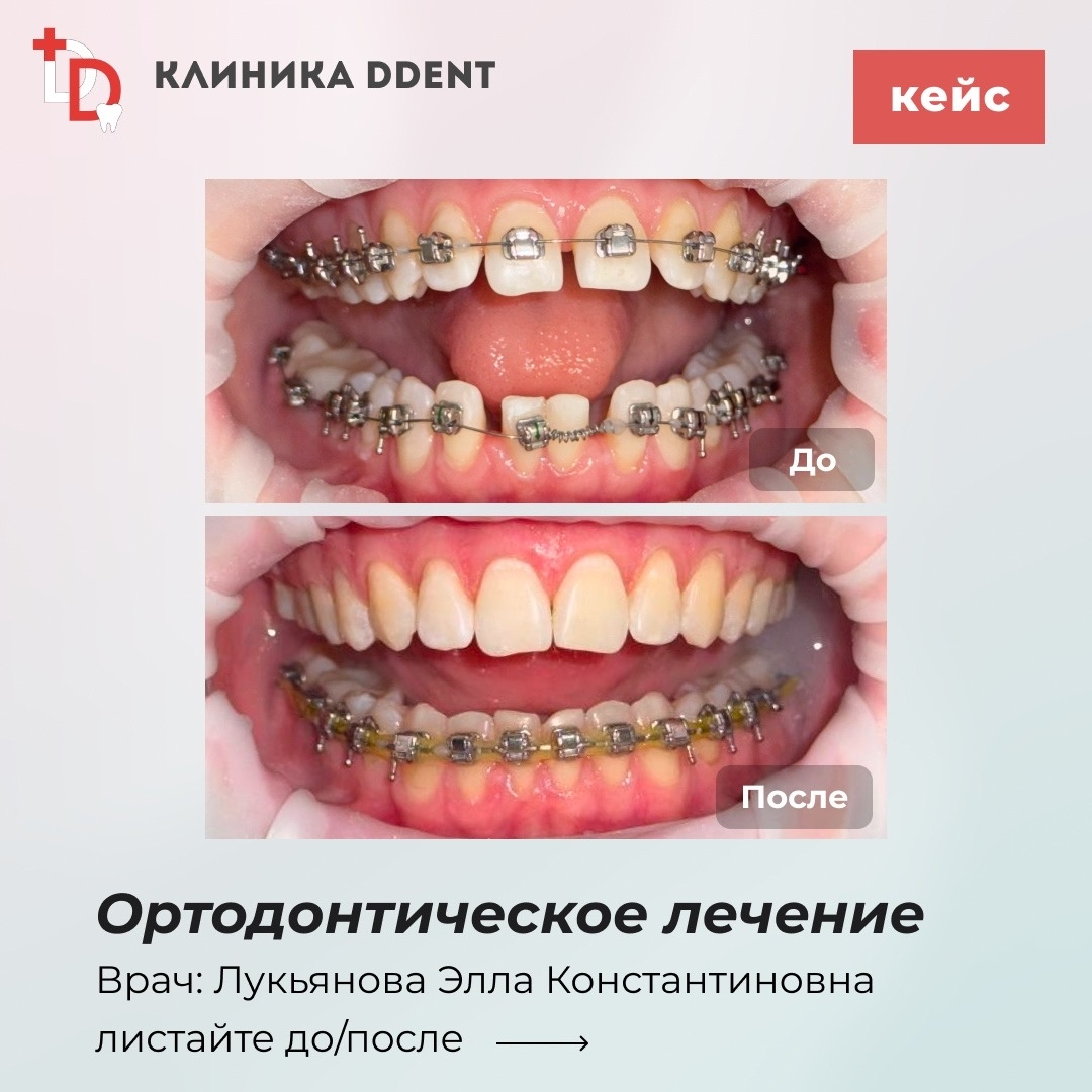 Ортодонтическое лечение — кейс 1