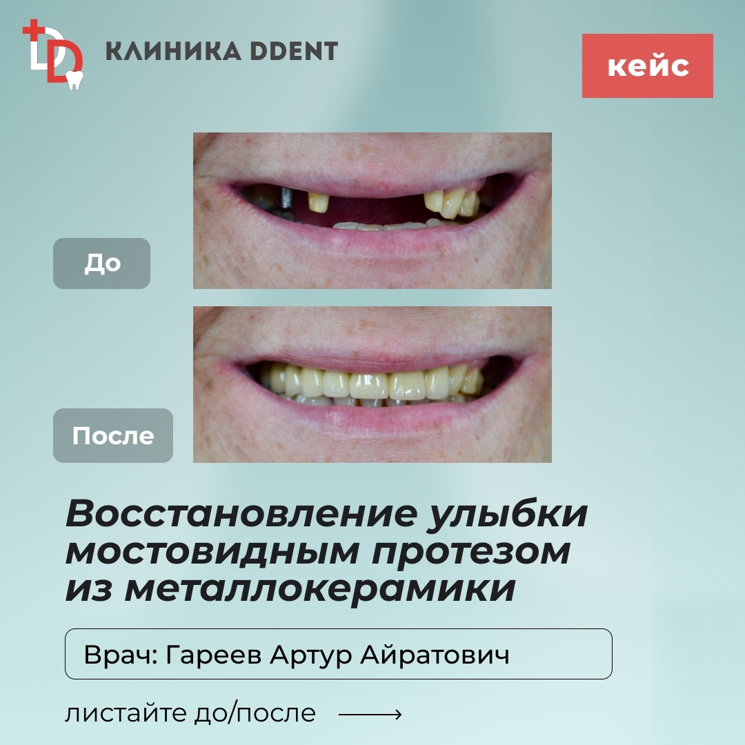 Восстановление улыбки мостовидным протезом