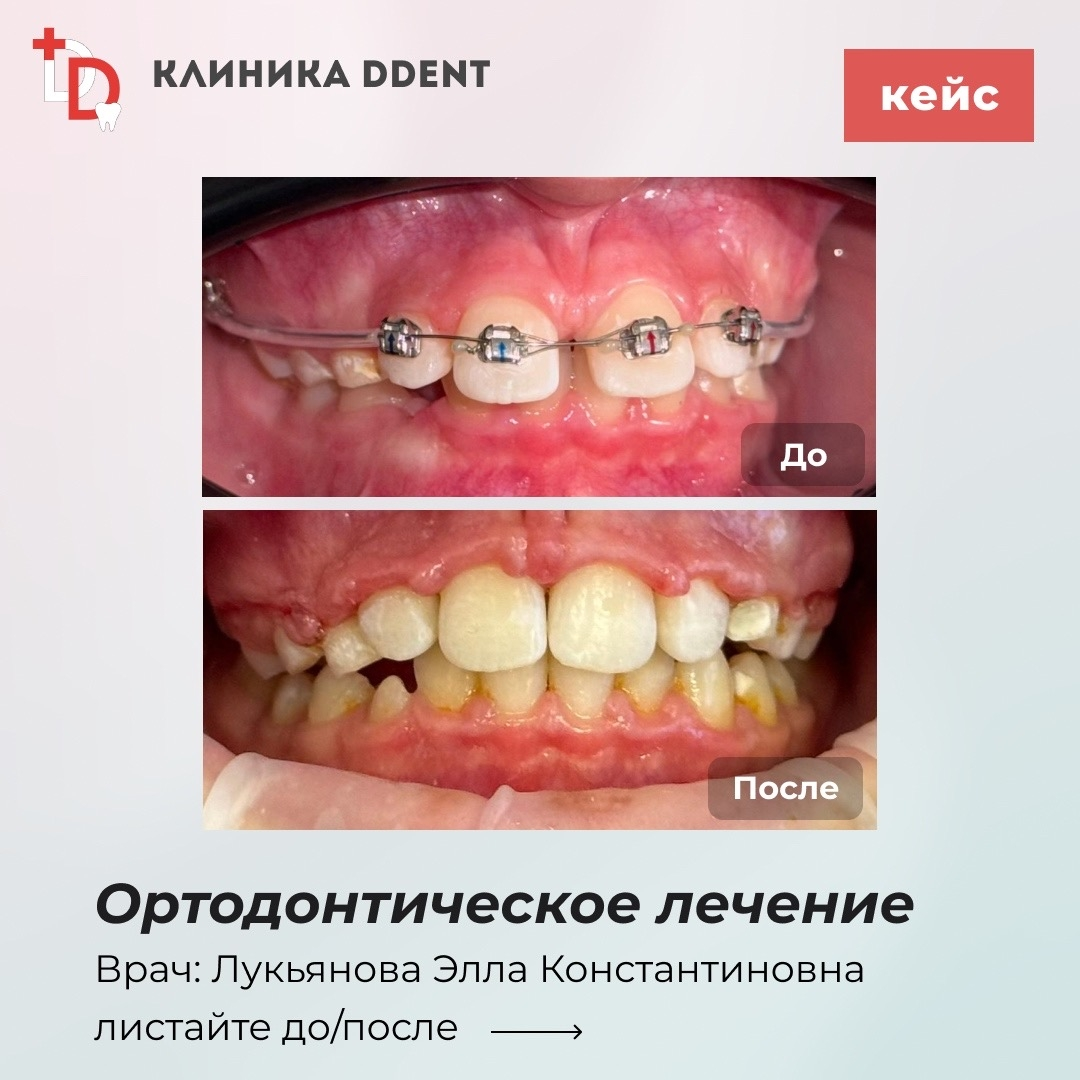 Ортодонтическое лечение — кейс 2