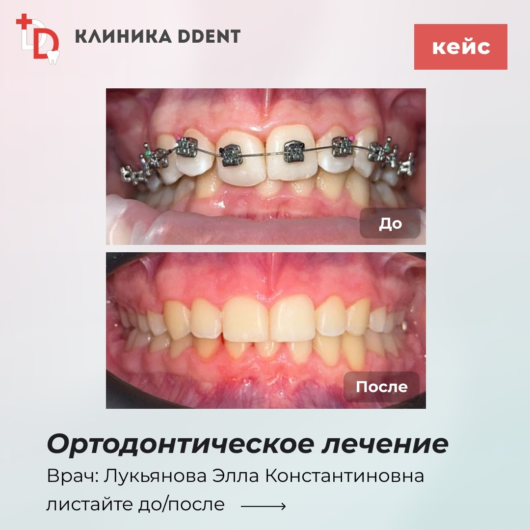 Ортодонтическое лечение — кейс 3