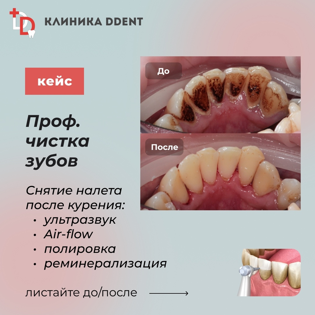 Профессиональная чистка зубов — кейс