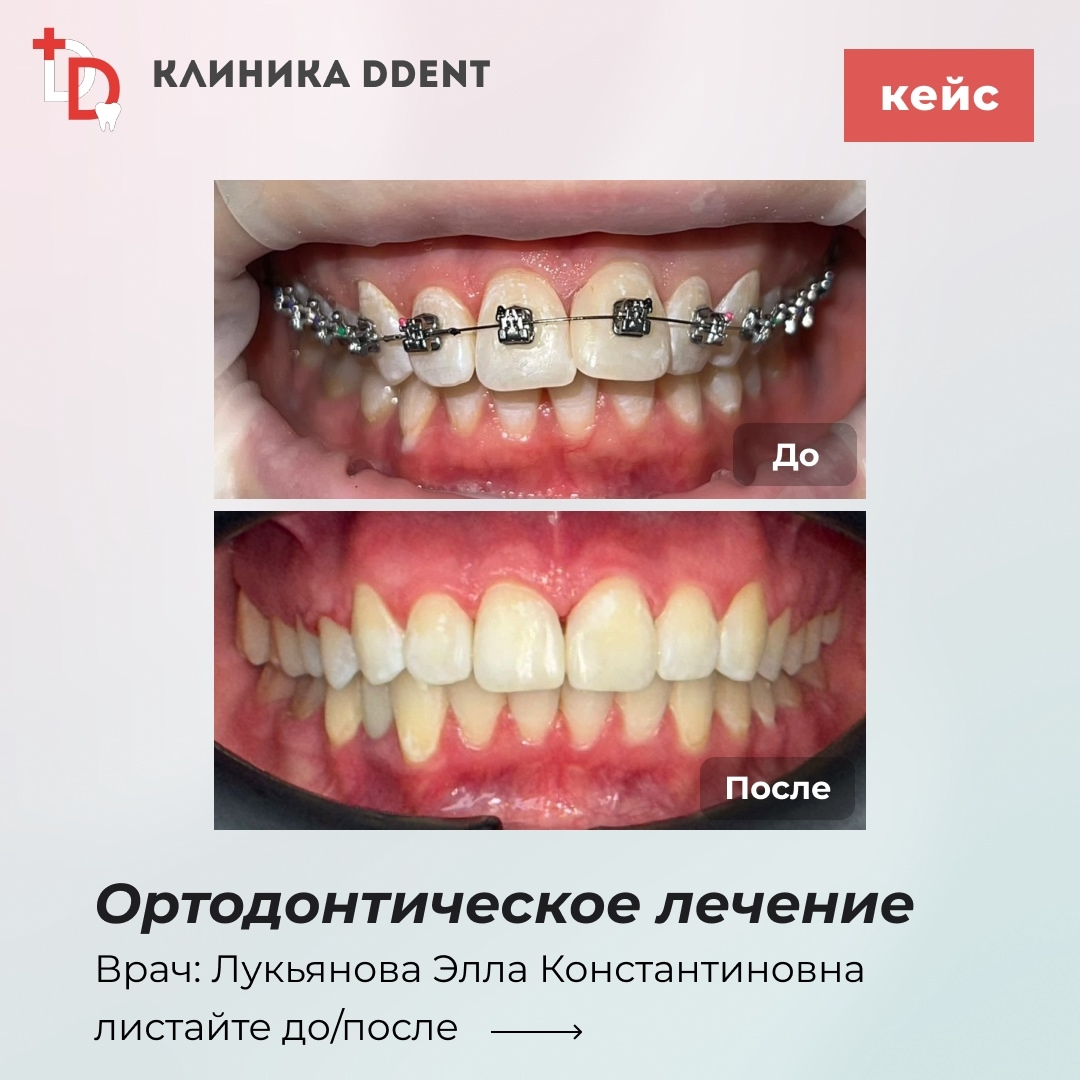Ортодонтическое лечение — кейс 4