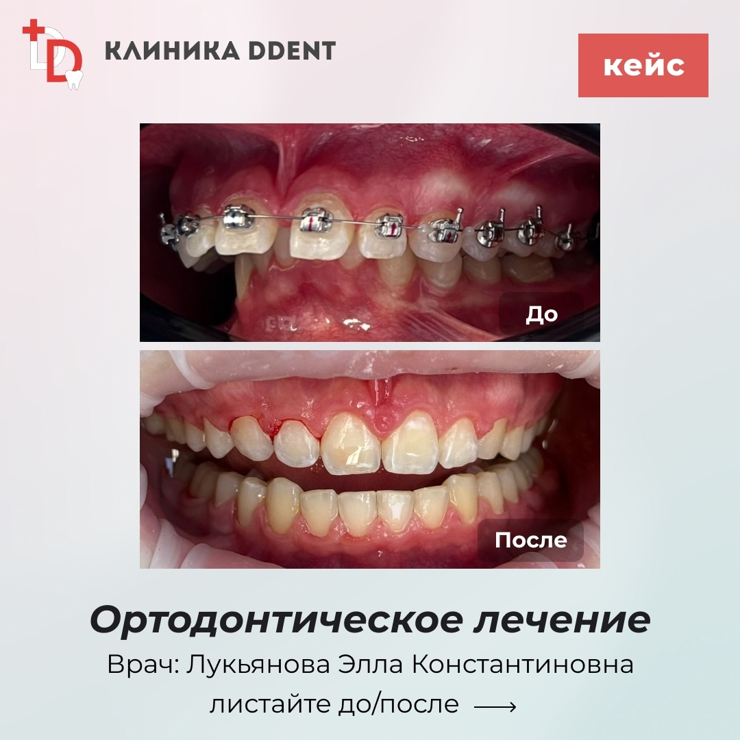 Ортодонтическое лечение — кейс 5