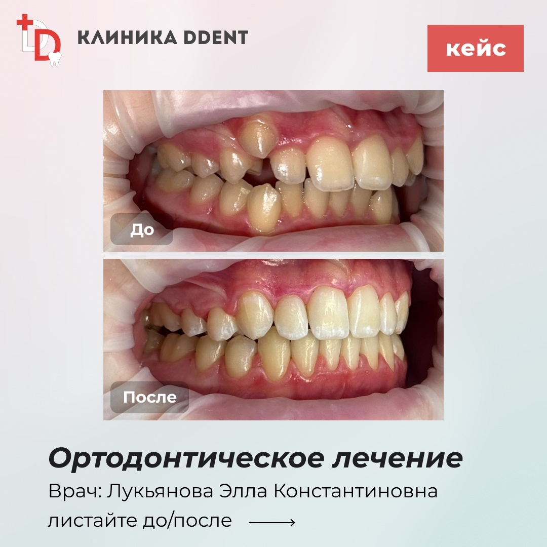 Ортодонтическое лечение — кейс 6
