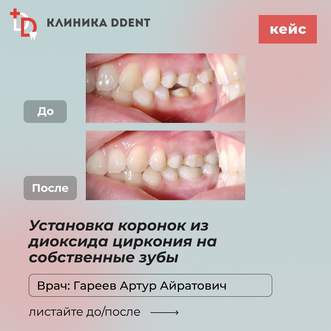 Установка коронок из диоксида циркония