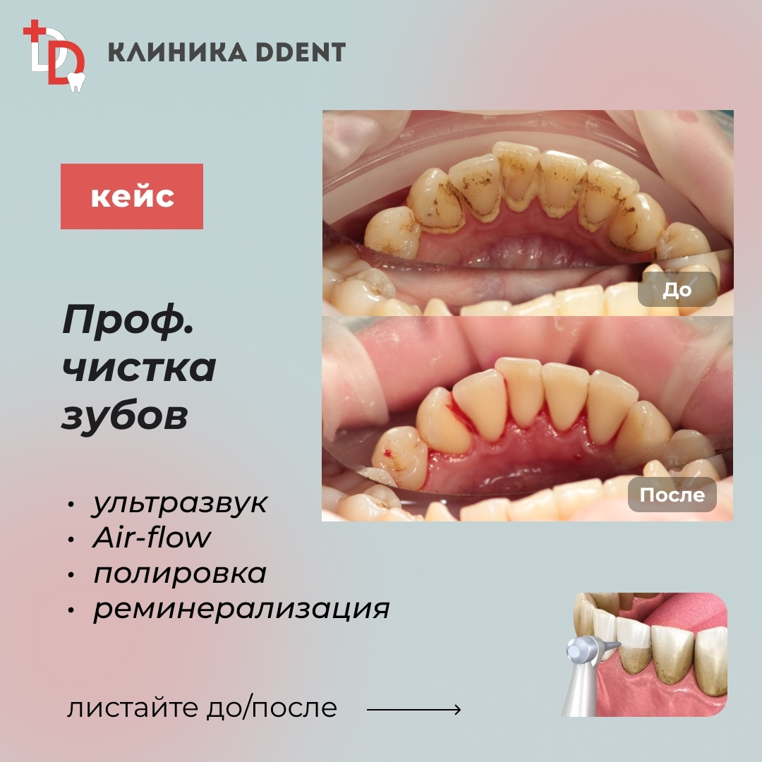 Профессиональная чистка зубов — кейс